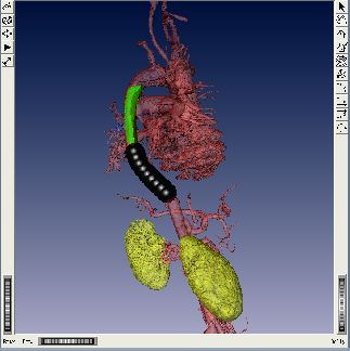 stent_intraoperational.jpg