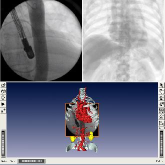 stent_optimization.jpg