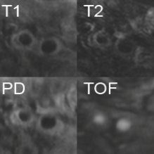 Non Invasive Histology of Atherosclerotic Plaque