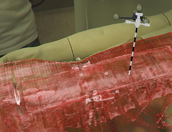 ARAV Augmented Reality Aided Vertebroplasty