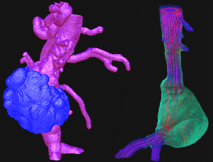 Prediction of Rupture Risk for Abdominal Aortic Aneurysms