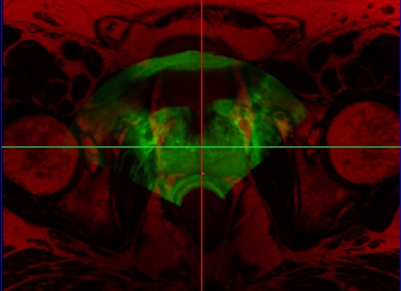 Prostate Fusion Biopsy