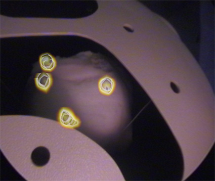 Freehand SPECT for Sentinel Lymph Node Localization