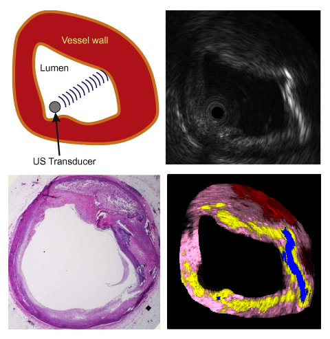 Ultrasound Based Tissue Characterization