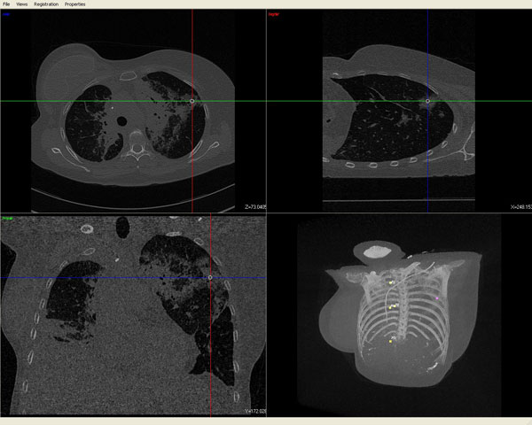 Navigated Bronchoscopy