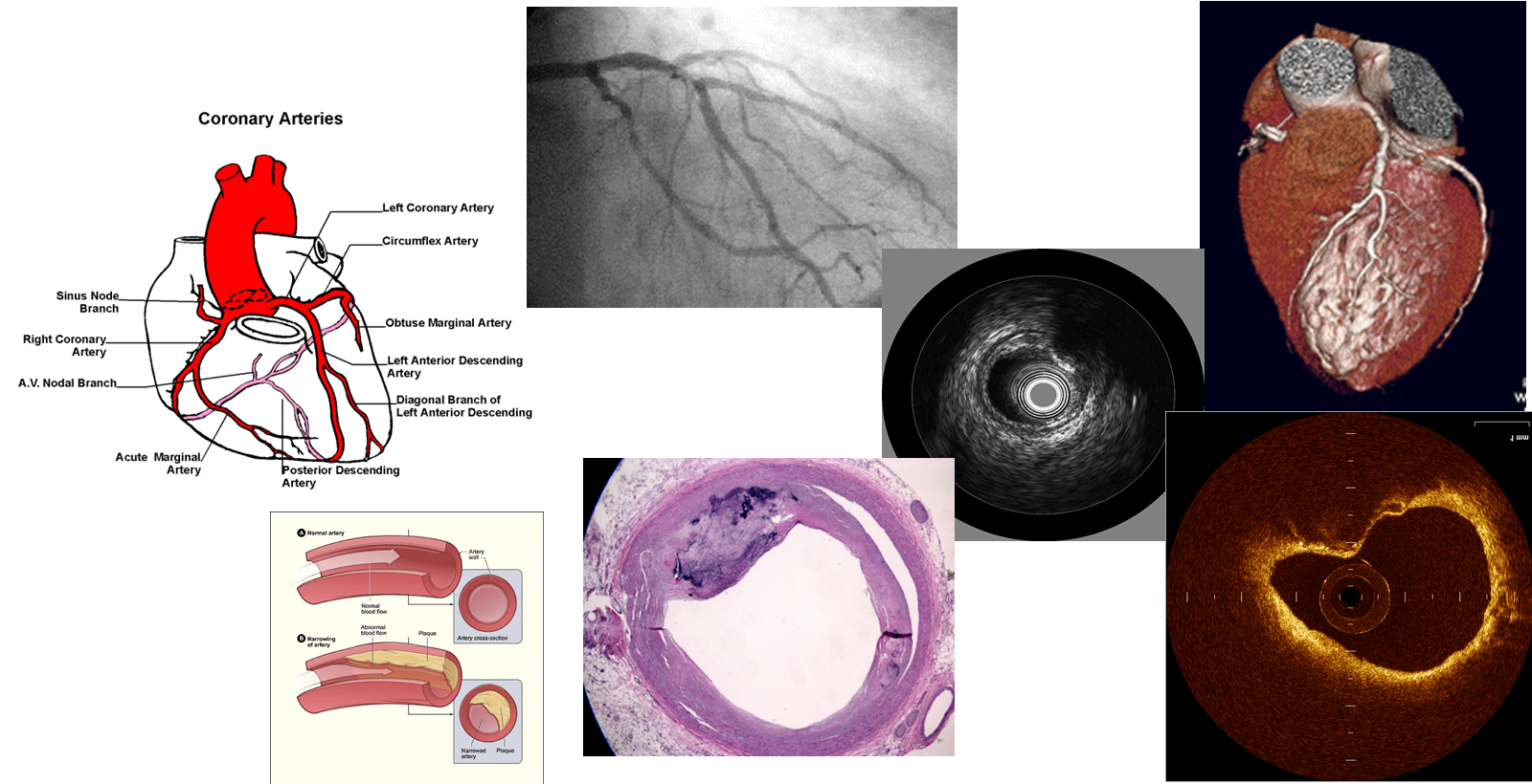 patient-Specific Translational research on Atherosclerosis and Diagnosis (STAnD)