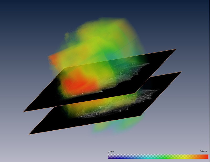 Ultrasound-Based Brainshift Estimation and Correction