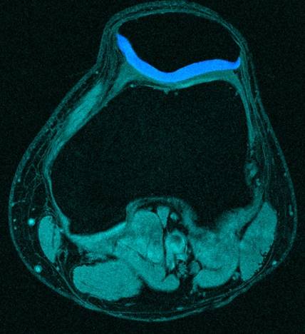 A segmented patella cartilage