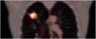 Lung Tumor in PET/CT image
