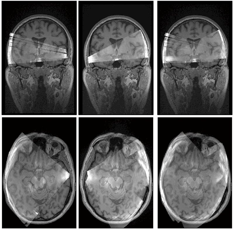 Bi-lateral 3D transcranial US scans with optically co-registered MRI.